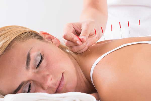 Acupuncture